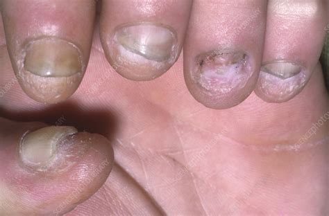 Psoriasis Of The Fingernails Stock Image C0494522 Science Photo