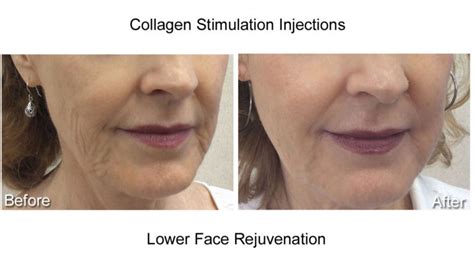 Collagen Stimulation Cairns Plastic Surgery Injectables