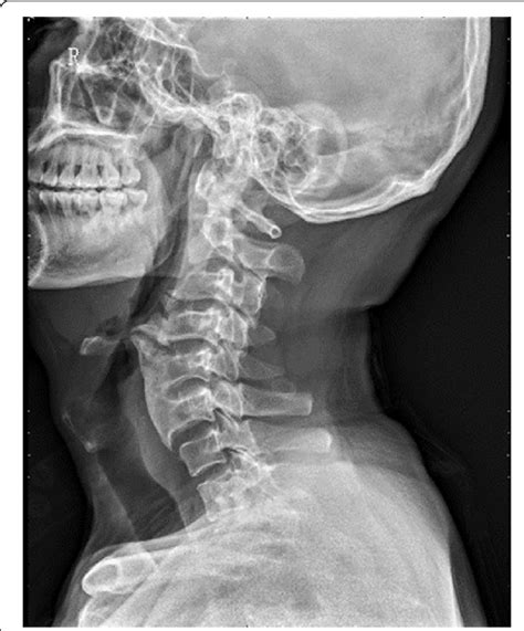 A Lateral Cervical Spine Radiograph Displayed Osteophyte From C3 To C6