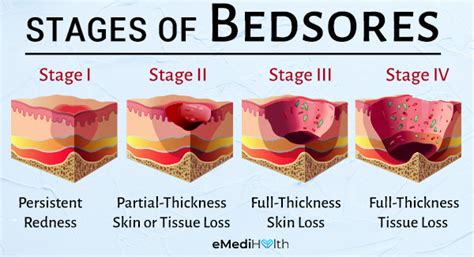 Bedsores Stages How To Heal Them Is Petroleum Jelly Good