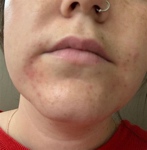 Skin Concerns Acne Around My Mouth Any Tips Skincareaddiction