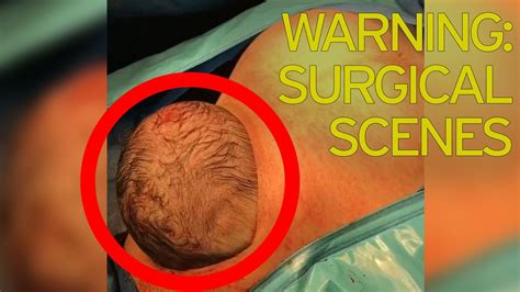 Newborn S Head Pops Out Of Mum S Stomach During Natural Cesarean