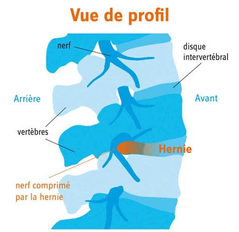 Hernie Discale Sympt Mes Causes Et Traitement M Dicaux Et Non M Dicaux La Vie Et La Science