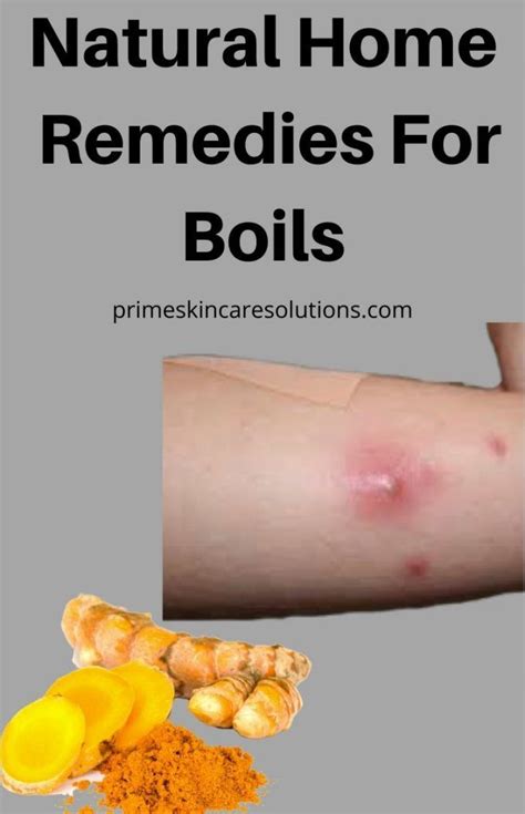 List Of Whats In Cure For Boils References