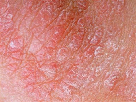 Skin Diseases Take Big Slice Out Of Americas Health Economy