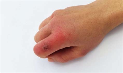 Chilblains Symptoms And Causes