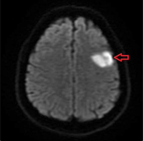 Mri Of The Brain With And Without Contrast Displayed Left Frontal Lobe