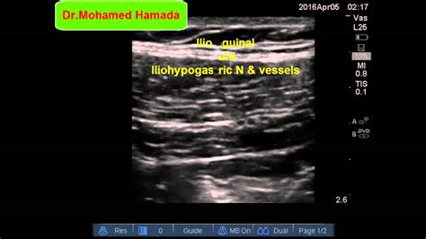 Ultrasound Guided Ilioinguinaliliohypogastric Nerve Block Youtube