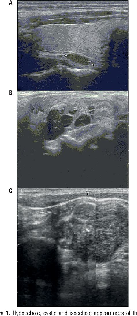 Figure 1 From Evaluation Of Preoperative Ultrasonographic And