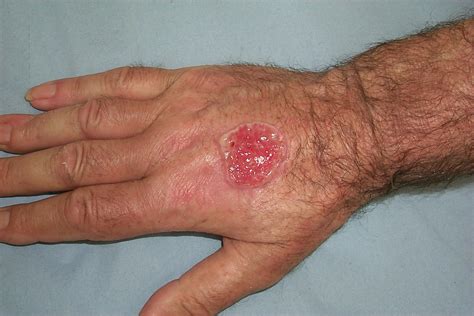 Wide Excision Of A Squamous Cell Carcinoma Similar To This On The Hand Suturing On Day
