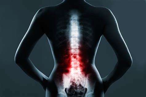 Dos And Donts After A Spinal Surgery