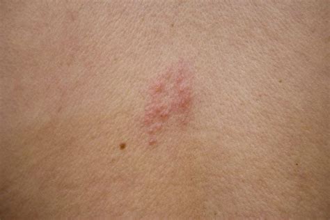 Signs Of Shingles Facty Health