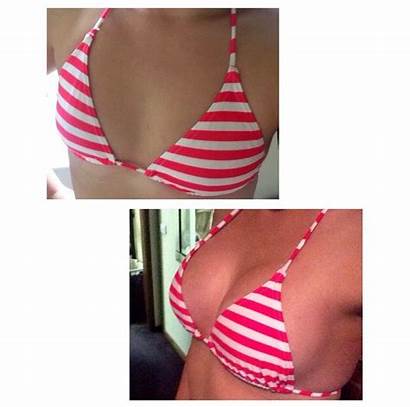 Amazing Transformations Contouring Surgery Implants Breast Before