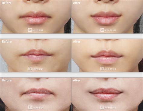 Get Upturned Lips Lipstutorial Org