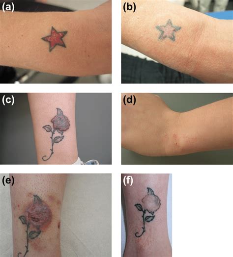 Ablative Fractional Laser Therapy In The Treatment Of Allergic Tattoo