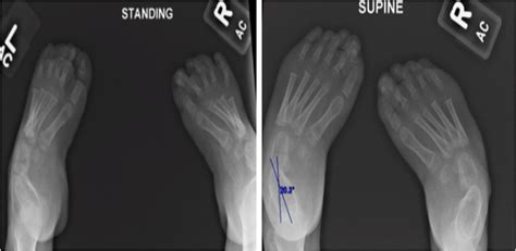 Figure 1 Foot X Ray Showing Bilateral Metatarsus Adductus Stacked