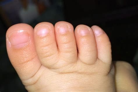 Webbed Toes Causes Diagnosis Surgery And Pictures