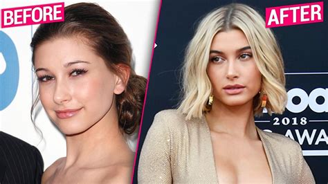 Hailey Baldwin’s Plastic Surgery Revealed By Top Doctors