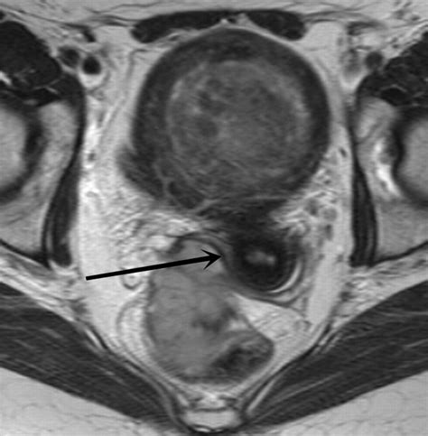 Mr Imaging Features Of Vaginal Malignancies Radiographics