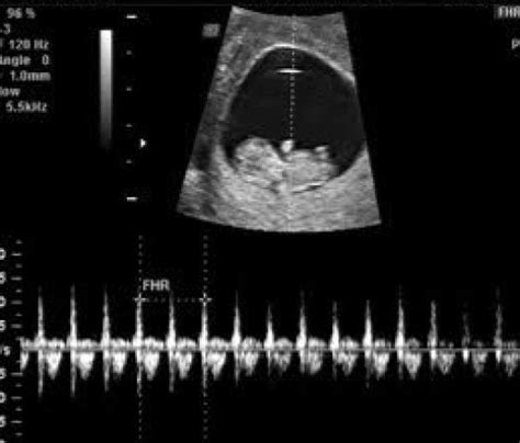 All About Normal 11 Week Ultrasound Nuchal Translucency