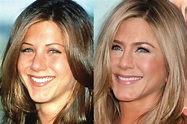 Jennifer Aniston's Plastic Surgery Journey - Vanity