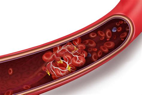 What To Know About Blood Clots Risks And Prevention
