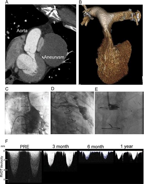 Acquired Right Ventricular Outflow Tract Rvot Obstruction Due To