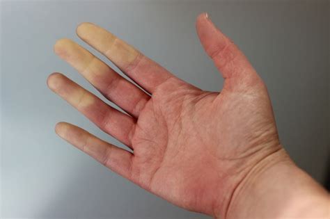 Raynauds Disease Types Symptoms And Treatment Live Science