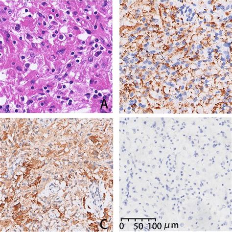 Histopathology Of Rosai Dorfman Disease From The First Download