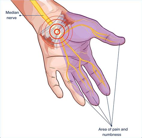 Numbness In Hands Treatment Kerala Regenerative Orthopaedics Treatment