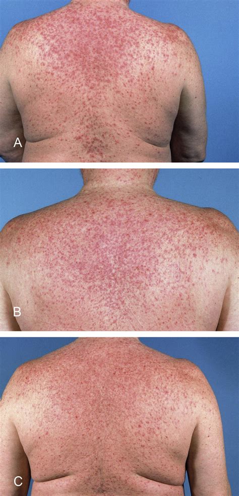 Recommendations On Management Of Egfr Inhibitor Induced Skin Toxicity