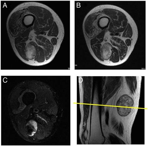 Necrotic Lipoma At The Posterior Thigh Mimicking Liposarcoma Bmj Case