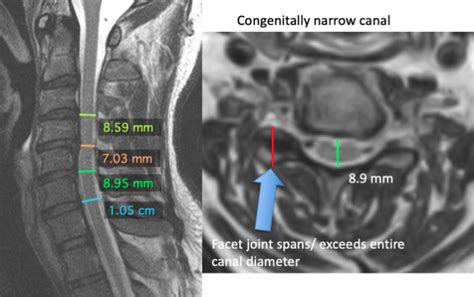 Cervical Spine Mri Comparison