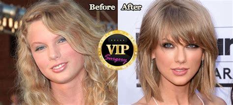 Taylor Swift Plastic Surgery News Before And After Plastic Surgery