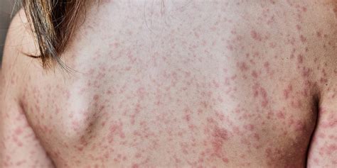 How To Tell The Difference Between Hives And A Rash According To