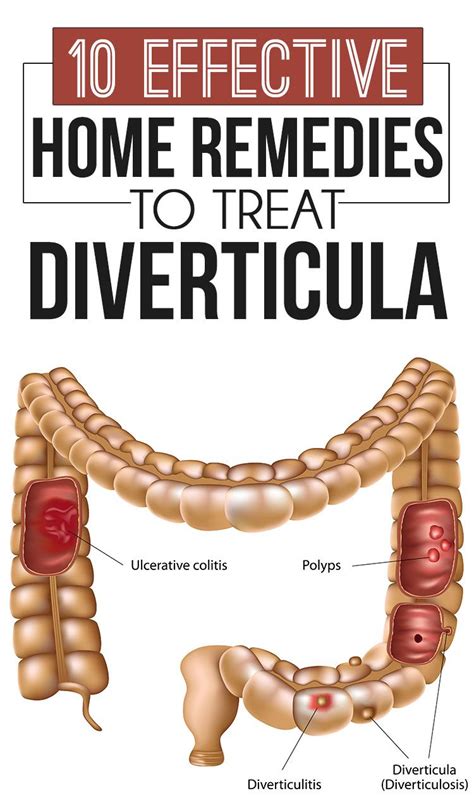 10 Effective Home Remedies To Treat Diverticula Diverticulitis