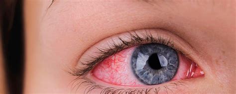 Беспокоит красный глаз воспаление Нужен офтальмолог Promed