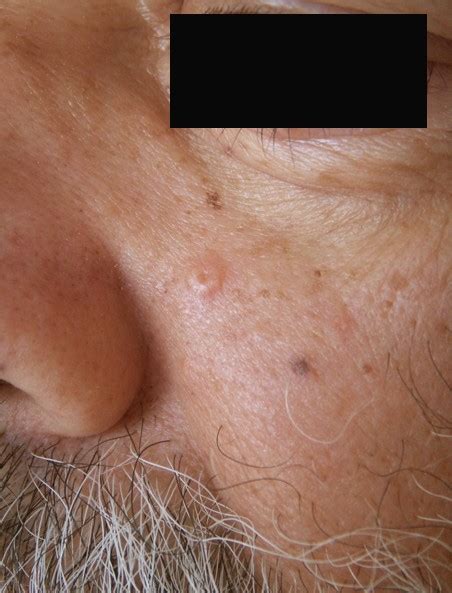 Sebaceous Hyperplasia Pictures Removal Symptoms Treatment Causes