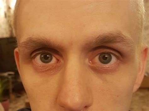 Wrinkled And Red Under Eyes Dermatology Forums Patient