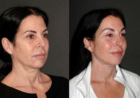 Deep Plane Facelift Results By Dr Andrew Jacono Surgery Journal Mini