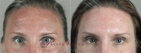 Nonsurgical Face Procedures Before And After Pictures Case 297