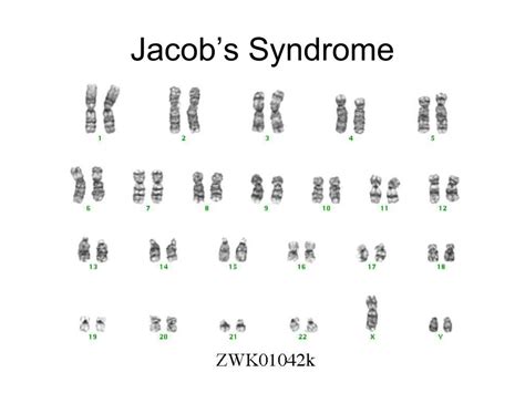 Jacobsen Syndrome Karyotype