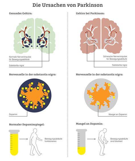 Parkinson Krankheit