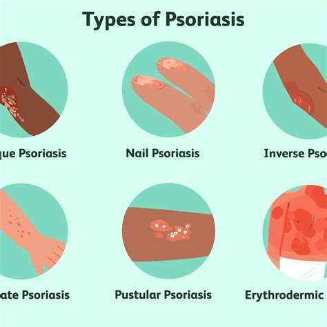 Wonderful Info About How To Heal Psoriasis Anxietyconcentrate