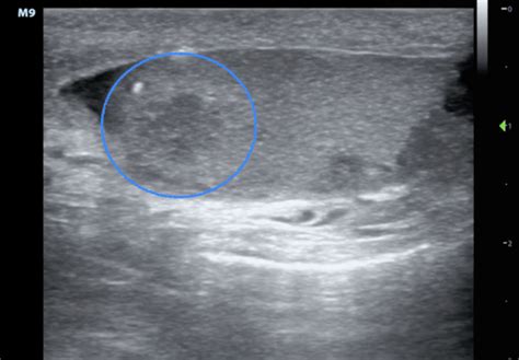 Hennepin Ultrasound Testicular Pain