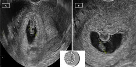 Chorionic Bump In Early Pregnancy Associated With First Trimester