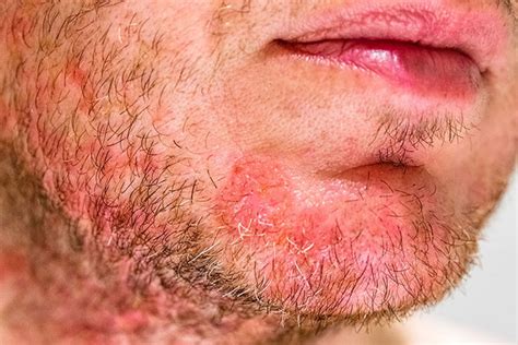 Demodex Mites The Microbiome And The Treatment Of Rosacea Bcp Skincare