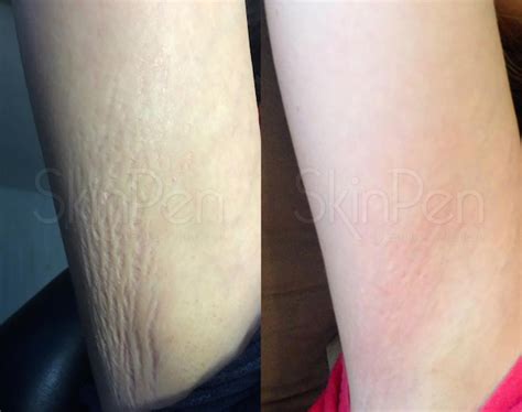 Scars And Stretch Marks Skin By Design Dermatology And Laser Center Pa
