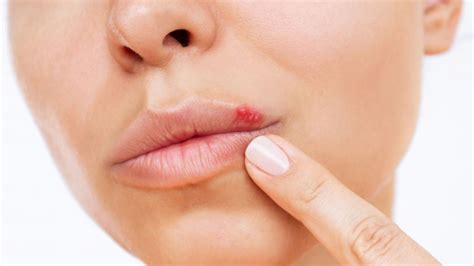 Como Tratar Feridas No Canto Da Boca