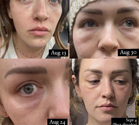 Allergic Reactionsudden Hardening Of Dermal Fillers Years After